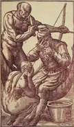 Medical fetish woodcut of a muscular bald man performing trepanation on a slim man with a blonde curvy woman watching.