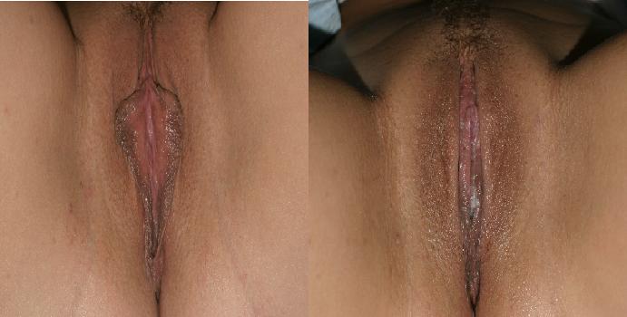 Vaginoplasty example, shown pre- and post-op.
